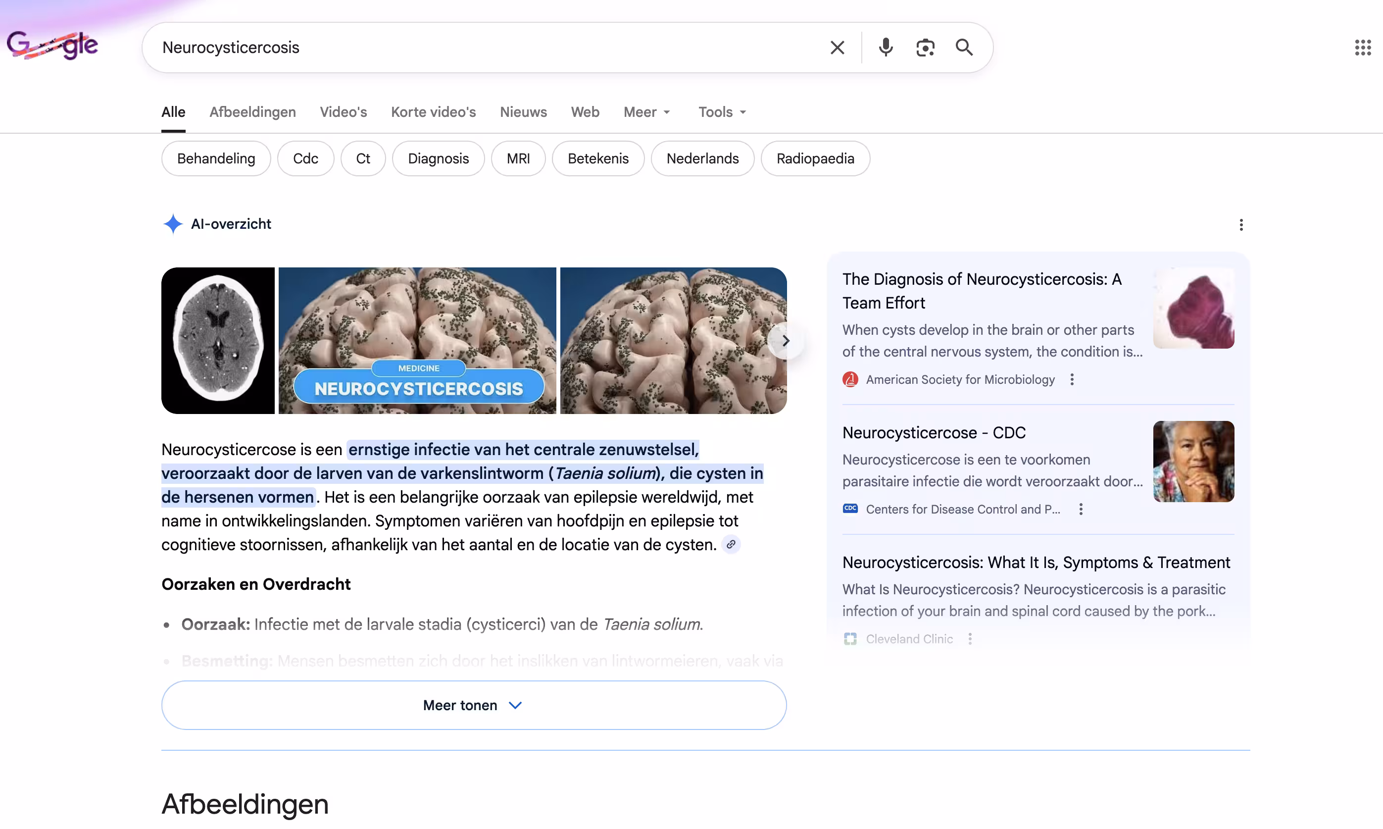 google-results-Neurocysticercosis