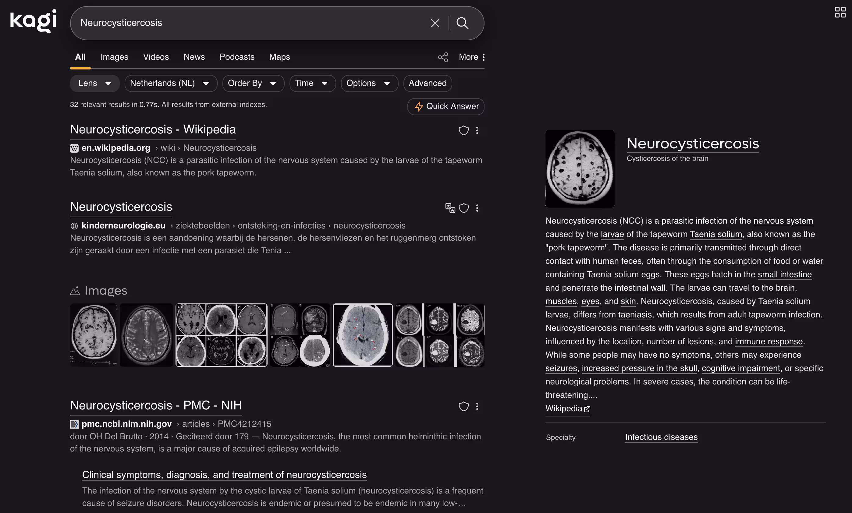 Kagi search results for Neurocysticercosis